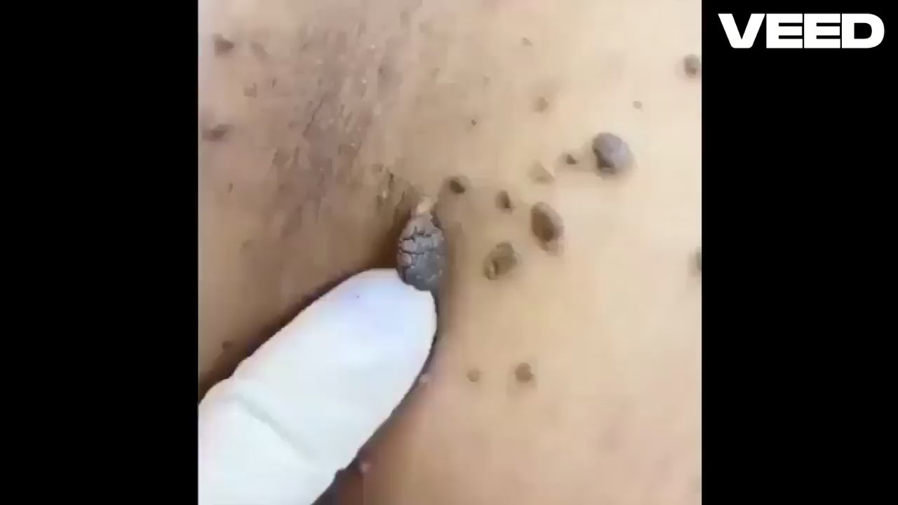 Warts Off Instant Blemish Removal Cream – Pain-Free Wart & Skin Tag Remover