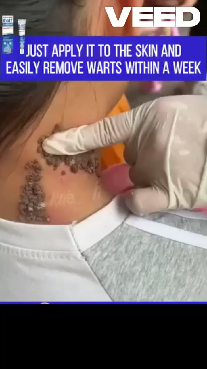 Warts Off Instant Blemish Removal Cream – Pain-Free Wart & Skin Tag Remover